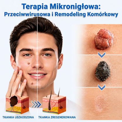 🏵️👍𝐌𝗢𝑷𝙍𝙊® 2 w 1 – mikronakłuwający i hydrokoloidowy plaster 🍀 | usuwa wypukłe znamiona, trądzik, płaskie brodawki i włókniaki skórne | wspiera redukcję zmarszczek, blizn i niedoskonałości | niewidoczne plastry do stosowania na twarz i ciało