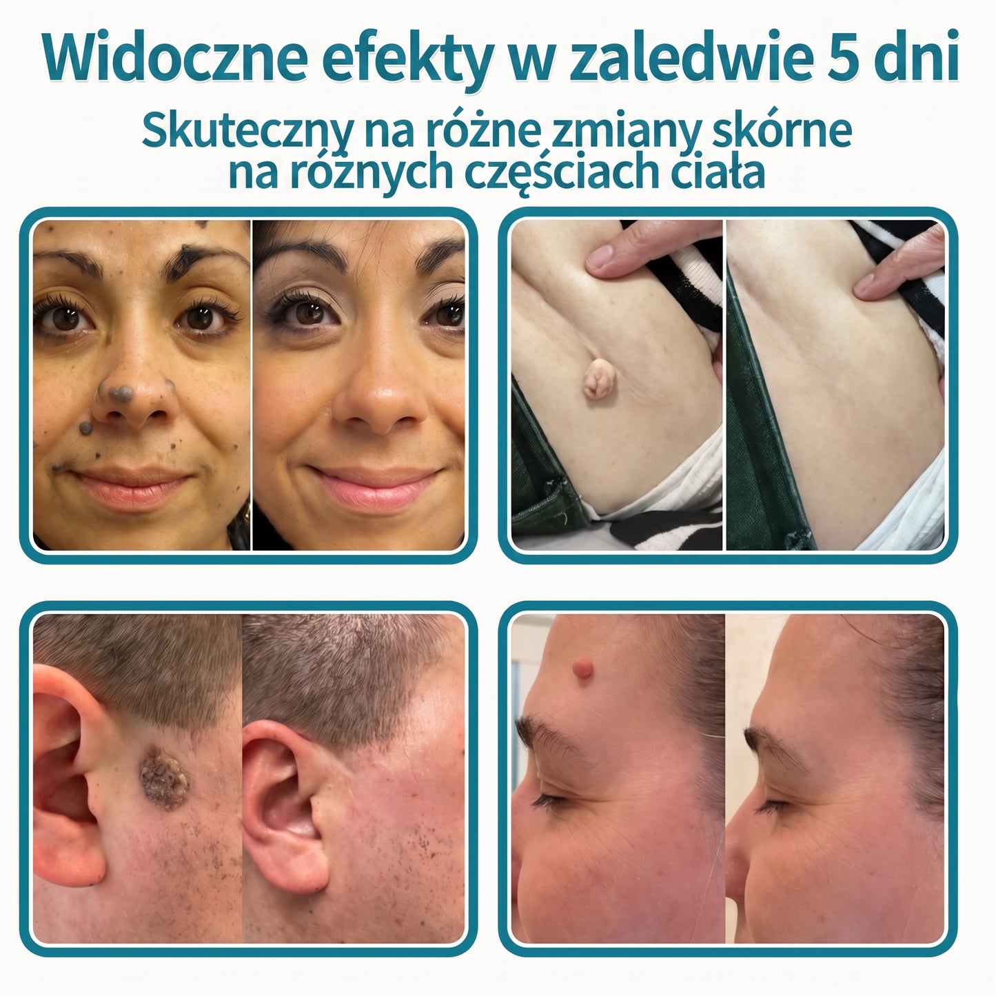 🦚🇵🇱 𝐇𝐞𝒂𝒍𝗿𝗶𝙯𝙚® 2-w-1 Plaster Mikronakłuwający i Hydrokoloidowy 🌿 | Usuwanie wypukłych znamion, trądziku, brodawek płaskich i włókniaków | | Pomaga poprawić wygląd zmarszczek, blizn i niedoskonałości skóry | | Niewidoczne plastry do twarzy i ciała |