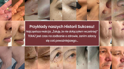 🏵️👍𝐌𝗢𝑷𝙍𝙊® 2 w 1 – mikronakłuwający i hydrokoloidowy plaster 🍀 | usuwa wypukłe znamiona, trądzik, płaskie brodawki i włókniaki skórne | wspiera redukcję zmarszczek, blizn i niedoskonałości | niewidoczne plastry do stosowania na twarz i ciało