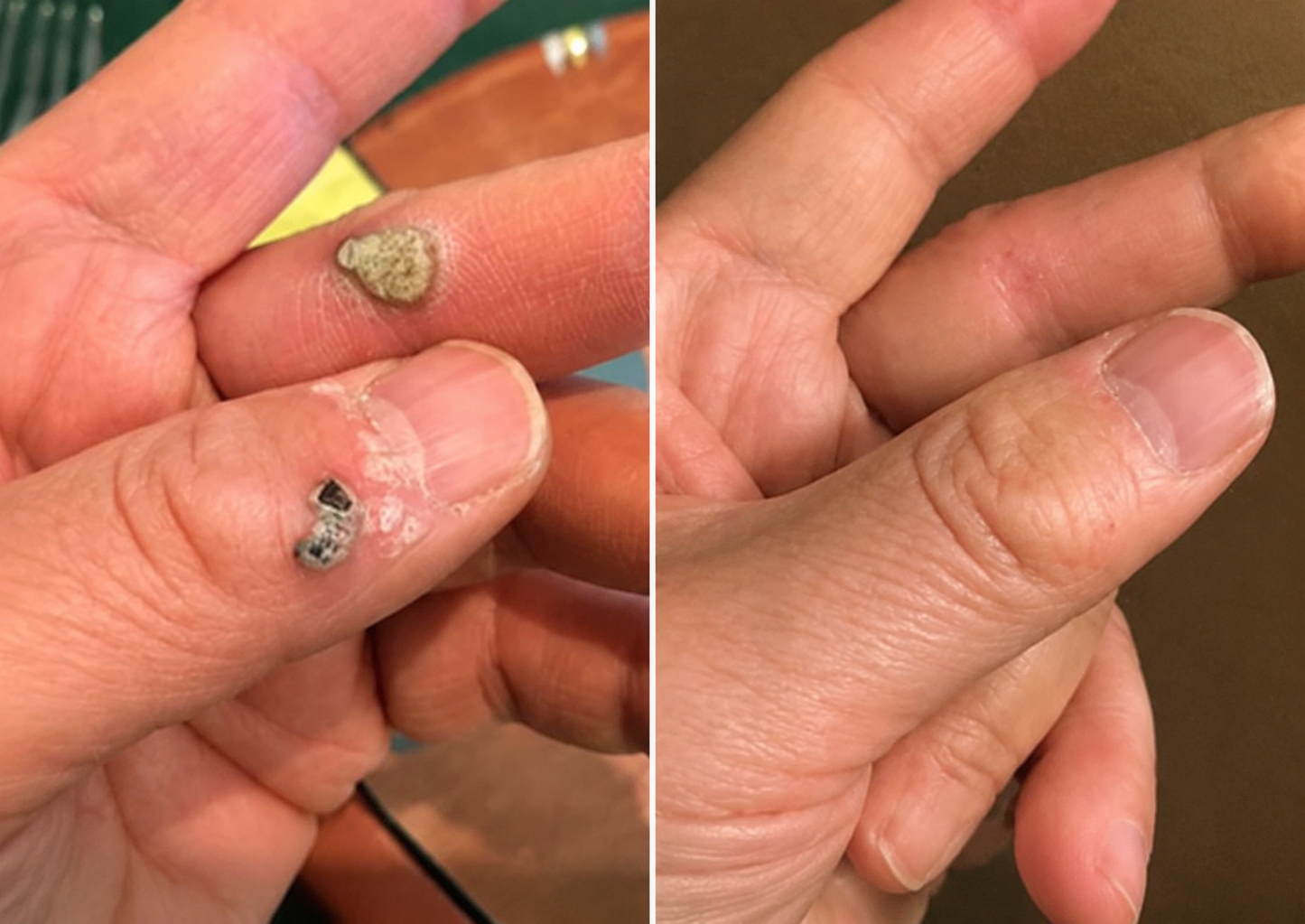 🏵️👍𝐌𝗢𝑷𝙍𝙊® 2 w 1 – mikronakłuwający i hydrokoloidowy plaster 🍀 | usuwa wypukłe znamiona, trądzik, płaskie brodawki i włókniaki skórne | wspiera redukcję zmarszczek, blizn i niedoskonałości | niewidoczne plastry do stosowania na twarz i ciało